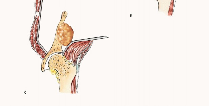 Illustration 20 for Pelvic Metastasis Surgery: A Component of the Utilitarian Approach