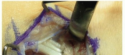 Illustration 17 for Why Anterior Tibialis Muscle Transfer Fixes Clubfoot