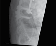 Illustration 9 for Mastering Thoracolumbar Surgery: Full Operative Planning