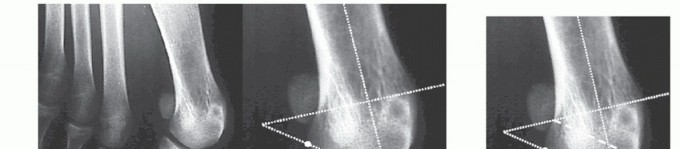 Illustration 5 for Mastering the Biplanar Distal Chevron for Effective Bunion Surgery