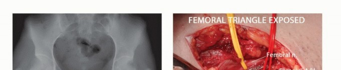 Illustration 35 for Pelvic Metastasis Surgery: A Component of the Utilitarian Approach