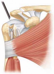 Illustration 9 for Resolve Long Head Biceps Pain: Advanced Arthroscopic Treatment