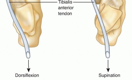 Illustration 2 for Why Anterior Tibialis Muscle Transfer Fixes Clubfoot