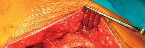 Illustration 25 for Direct Lateral Hip: Optimize Exposure with Sharp Curved Hohmann