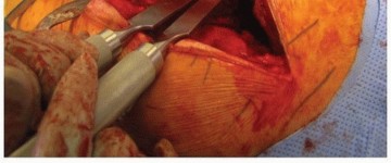 Illustration 16 for Extended Trochanteric Osteotomy: How et al Extended Revision THA Solutions