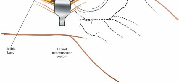 Illustration 227 for Mastering Knee Approaches: Spotlight on Superficial Medial Ligament