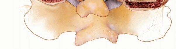 Illustration 13 for Achieve Stability: Posterior Cervical Lateral Mass Screw Fusion