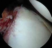 Illustration 10 for Regain Stability: Anterior Shoulder Instability Arthroscopic Fix
