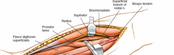 Illustration 12 for Radius Anterior Approach: Safe Nerve Protection & Complete Exposure