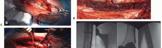 Illustration 19 for Mastering Fixation of Periprosthetic Fractures of the Femur