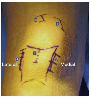 Illustration 20 for Optimizing Intramedullary Nailing for Tibial Shaft Fractures