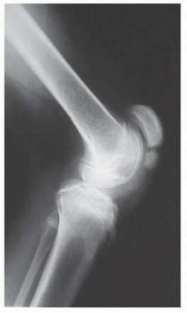 Illustration of medial hamstring muscles - Dr. Mohammed Hutaif