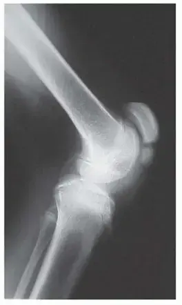 تطويل أوتار الركبة الخلفية للأطفال: استعيدوا خطواتهم الواثقة مع الدكتور محمد هطيف