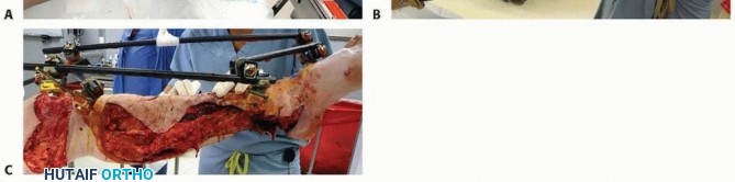 Illustration 16 for Tibia External Fixation: See How Pins Are Placed for Healing