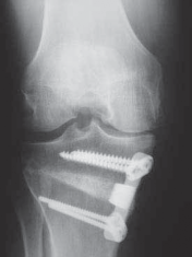 Illustration 42 for Guide Pin Assembly: Key to Flawless Upper Tibial Osteotomy
