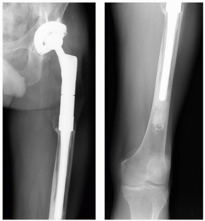 Illustration 3 for Allograft Prosthetic Composite: Mastering Proximal Femur Reconstruction