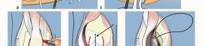 Illustration 45 for Treatment for Congenital Femoral Deficiency: What You Need to Know