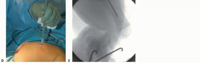Illustration 16 for Less Pain, More Function: Fassier-Duval Nailing for Osteogenesis Imperfecta
