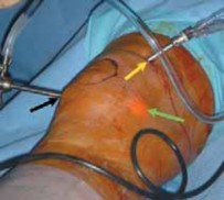 Illustration 10 for Microfracture Chondroplasty: How Tiny Holes Are Made to Fix Cartilage