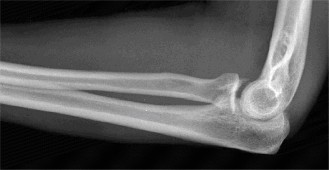 Illustration 68 for Right Shoulder Pain? Avoid This Common X-ray Mistake.