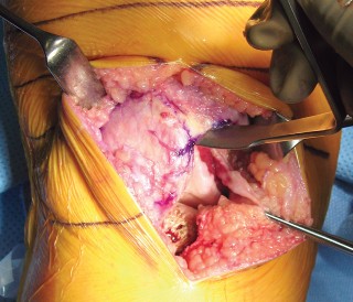 Illustration 7 for Minimally Invasive Subvastus: The Best Path to Quicker TKA Recovery