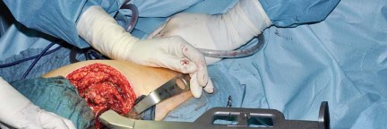 Illustration 50 for Collum Femoris Preserving: Achieve Better Primary Hip Outcomes