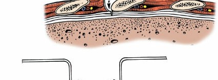 Illustration 318 for Approach to the Lumbar Spine: Mastering Techniques & Anatomy