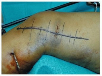 Illustration 37 for Repairing Distal Femur Fractures: Open Reduction & Internal Fixation