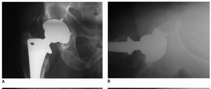 Illustration 8 for Osteolysis Solved: Polyethylene Liner Exchange for Well-Fixed Components