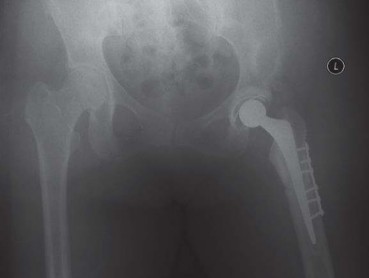 Illustration 148 for Successful Total Hip Replacement in Developmental Dysplasia