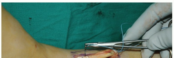 Illustration 52 for Restore Movement: Tendon Transfer for Common Peroneal Nerve Foot Drop