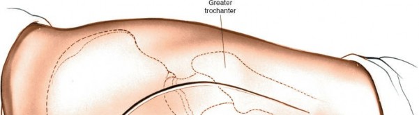 Illustration 174 for Unlocking Every Aspect of the Hip's Surgical Approaches