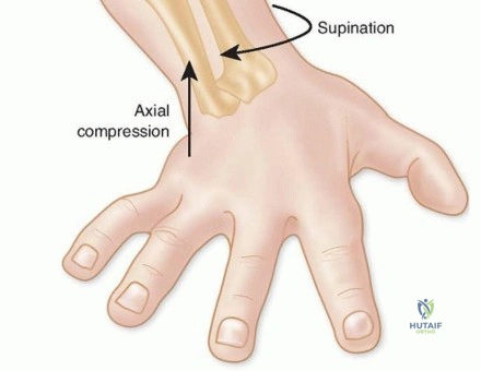 صورة توضيحية لـ خلع الورك التطوري (DDH) لدى الأطفال والكبار: دليل شامل للعلاج والوقاية مع الأستاذ الدكتور محمد هطيف