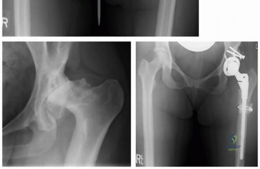 صورة توضيحية لـ إعادة بناء مفصل الورك المعقد لخلع الورك التنموي (DDH) باستخدام ترقيع رأس الفخذ الذاتي في صنعاء