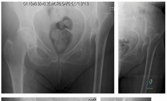 صورة توضيحية لـ إعادة بناء مفصل الورك المعقد لخلع الورك التنموي (DDH) باستخدام ترقيع رأس الفخذ الذاتي في صنعاء