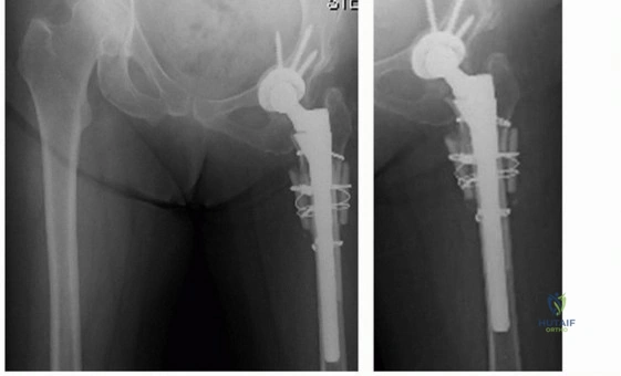 صورة توضيحية لـ إعادة بناء مفصل الورك المعقد لخلع الورك التنموي (DDH) باستخدام ترقيع رأس الفخذ الذاتي في صنعاء