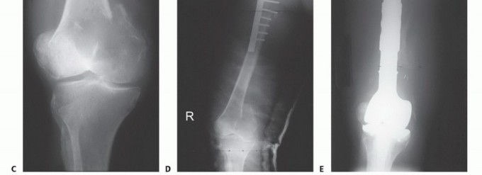 Illustration 7 for Plain Radiograph Showing MBD: Surgical Planning to Prevent Failures