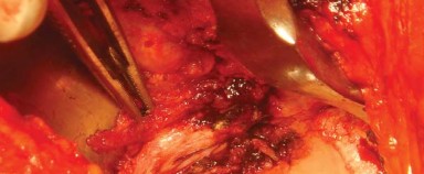 Illustration 14 for Approaches Posterolateral Surgical: A Guide to Enhanced Hip Surgery