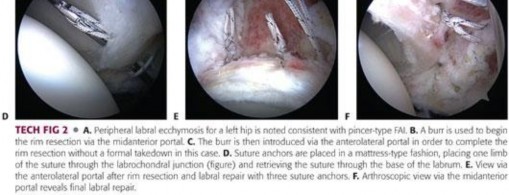 Illustration 117 for Mastering the Scope for Femoroacetabular Impingement