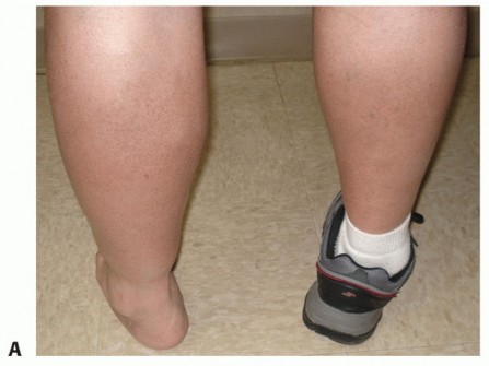 Unlock Stability: Medullary Nail Fixation for Tibiotalocalcaneal Arthrodesis