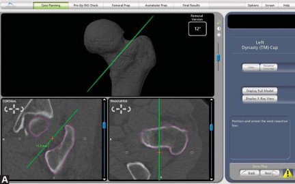 Illustration 21 for Robotics in Total Hip Arthroplasty: A New Era of Precision