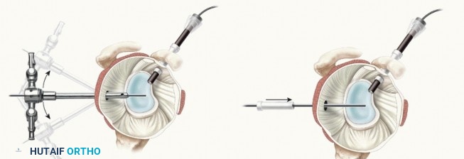 Illustration 16 for Stiff Shoulder? Discover Arthroscopic Capsular Release Solutions