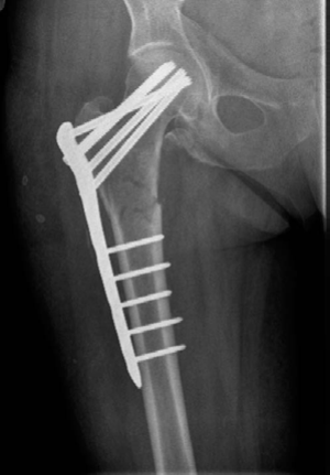 Illustration 2 for Lower Limb Trauma: Decipher Anteroposterior (AP) Figure for Exams