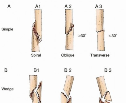 Antegrade Nailing of the Femur: Essential Techniques for Mastery