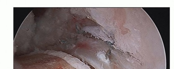 Illustration 24 for Hip Arthroscopy: Your Minimally Invasive Solution for Hip Pain