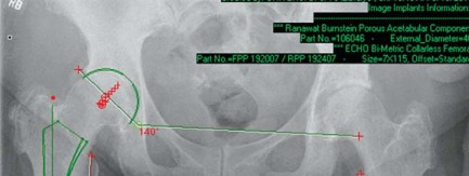 Illustration 19 for Maximize Success: Preoperative planning in primary Hip Replacement