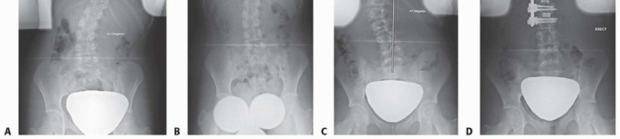 Illustration 4 for Anterior Interbody Arthrodesis for Scoliosis: What You Need to Know