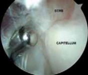 Illustration 8 for Unlock Relief: Arthroscopic Treatment of Epicondylitis Explained