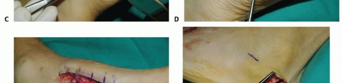 Illustration 79 for Mastering Midfoot Arthrodesis: Protect the Deep Neurovascular Bundle