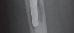 Illustration 47 for Femoral Stem Revision: Posterior Approach for Better Outcomes